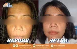 Perbandingan kondisi kulit sebelum dan sesudah perawatan di Be Hati