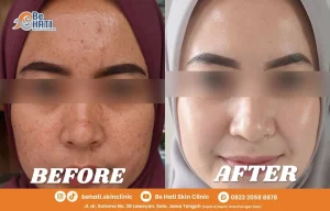 Before after perawatan di Be Hati