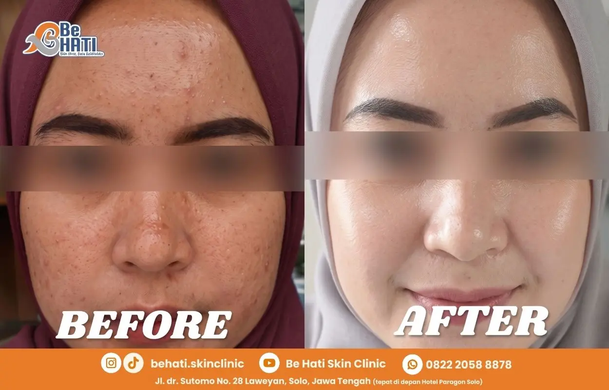 Before after perawatan di Be Hati 