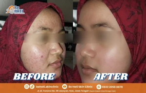 SkinJourney Be Hati Lovers