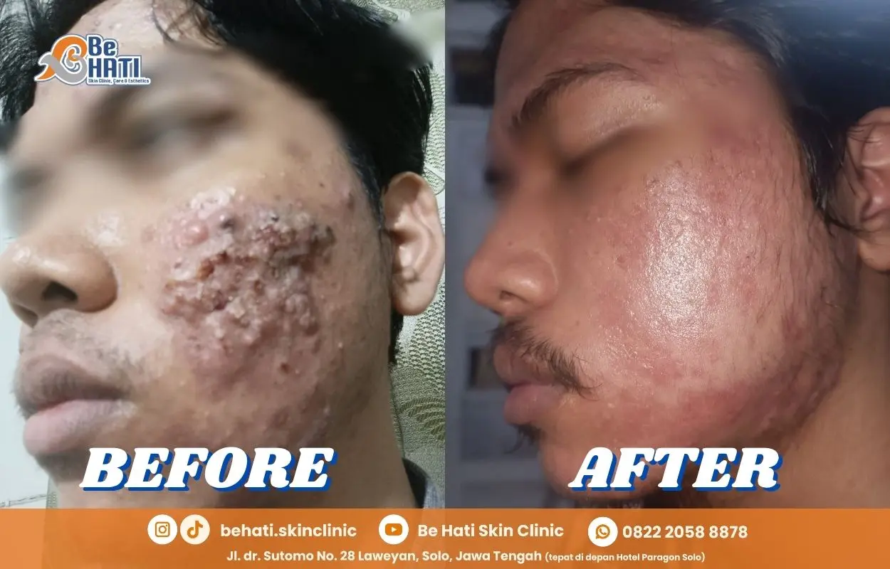 Perbandingan sebelum dan setelah perawatan di Be Hati