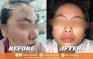 Jerawat & bopeng sembuh di Be Hati