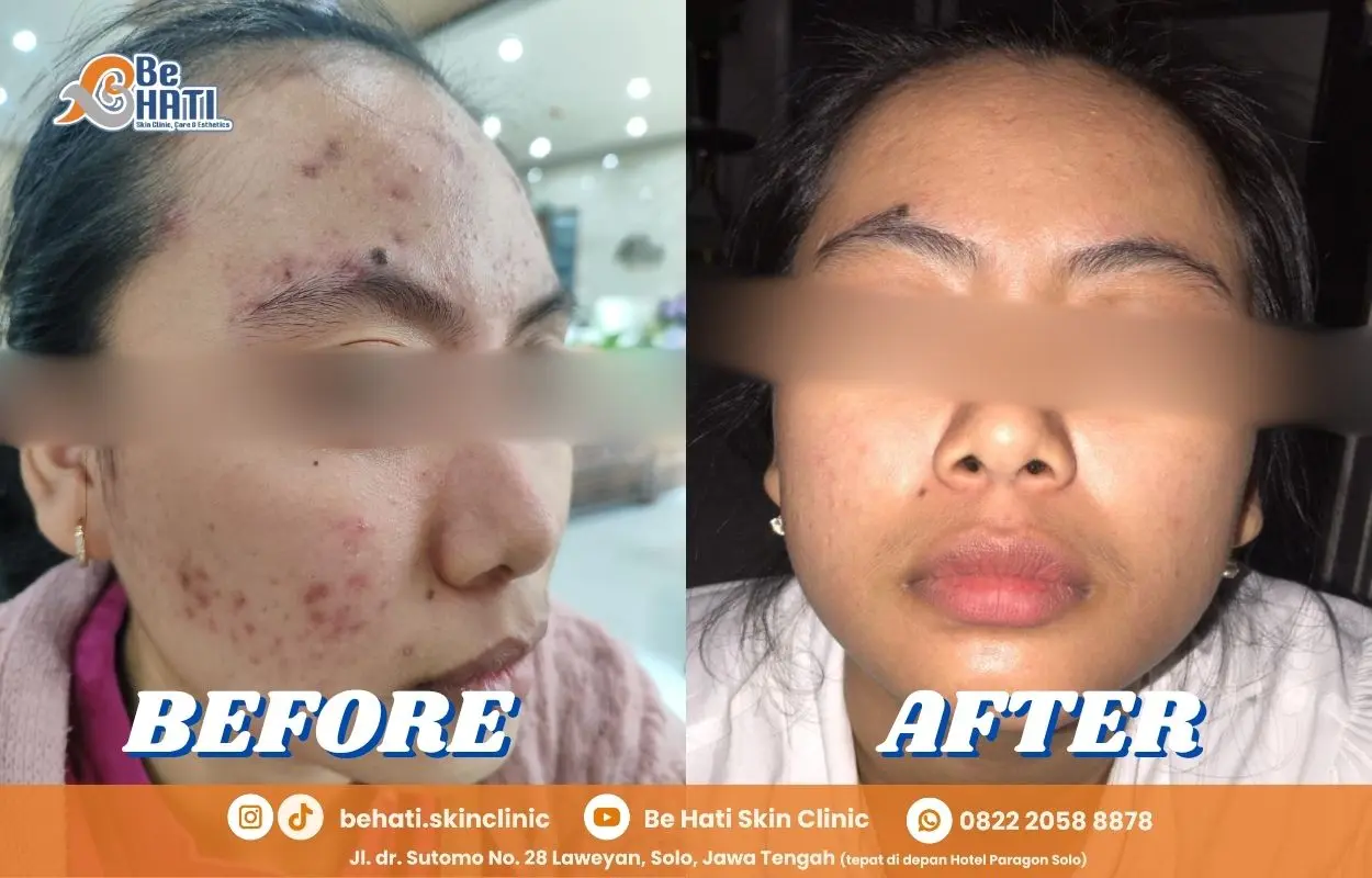 Jerawat & bopeng sembuh di Be Hati