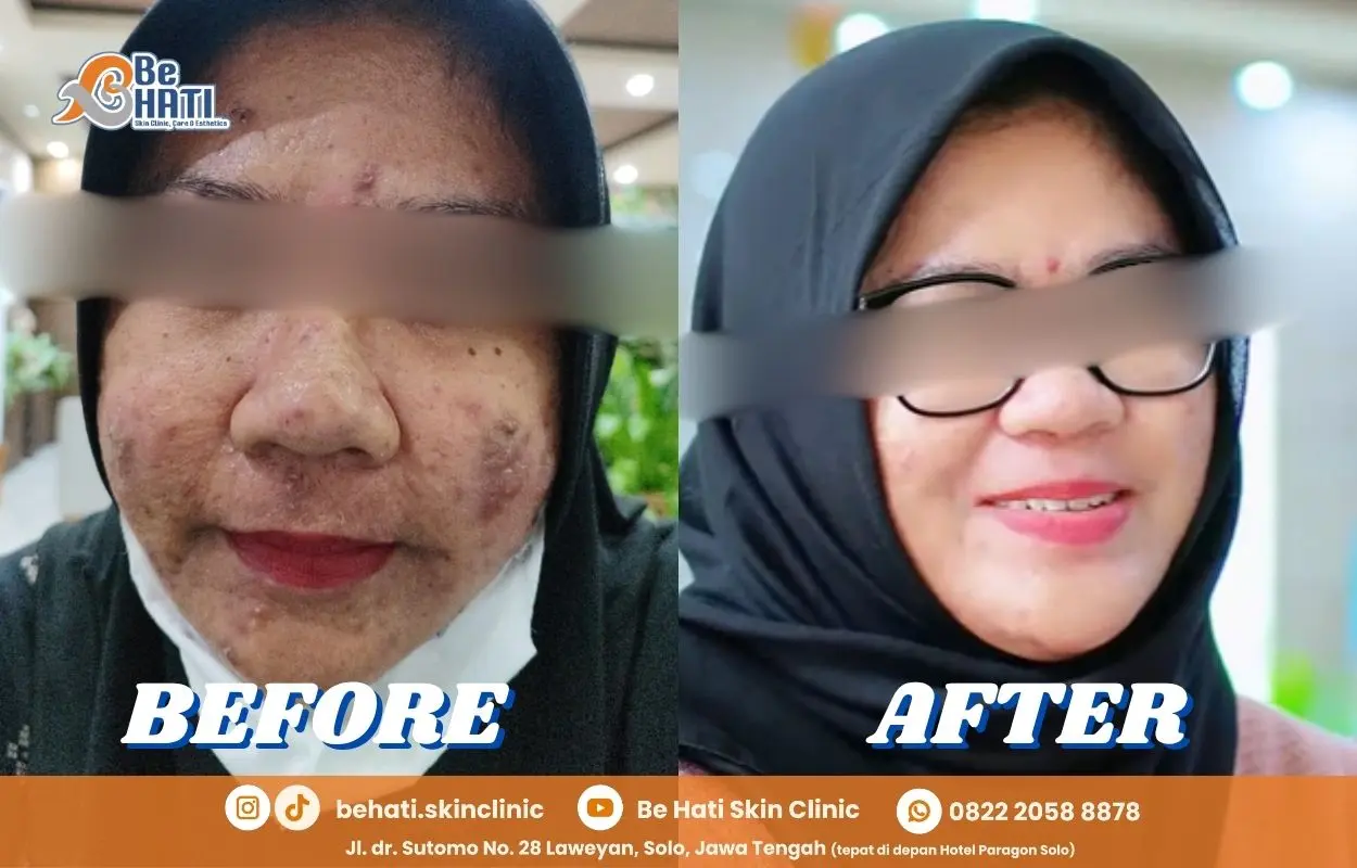 Perbandingan kulit berjerawat sebelum & setelah perawatan di Be Hati