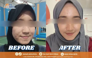 Kulit berjerawat sembuh di Be Hati
