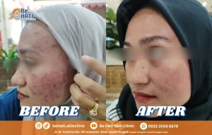 Perbandingan sebelum dan setelah perawatan di Be Hati