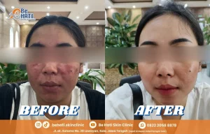 Perbandingan sebelum dan setelah perawatan di Be Hati