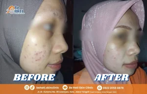 Perbandingan kondisi kulit sebelum dan sesudah perawatan di Be Hati