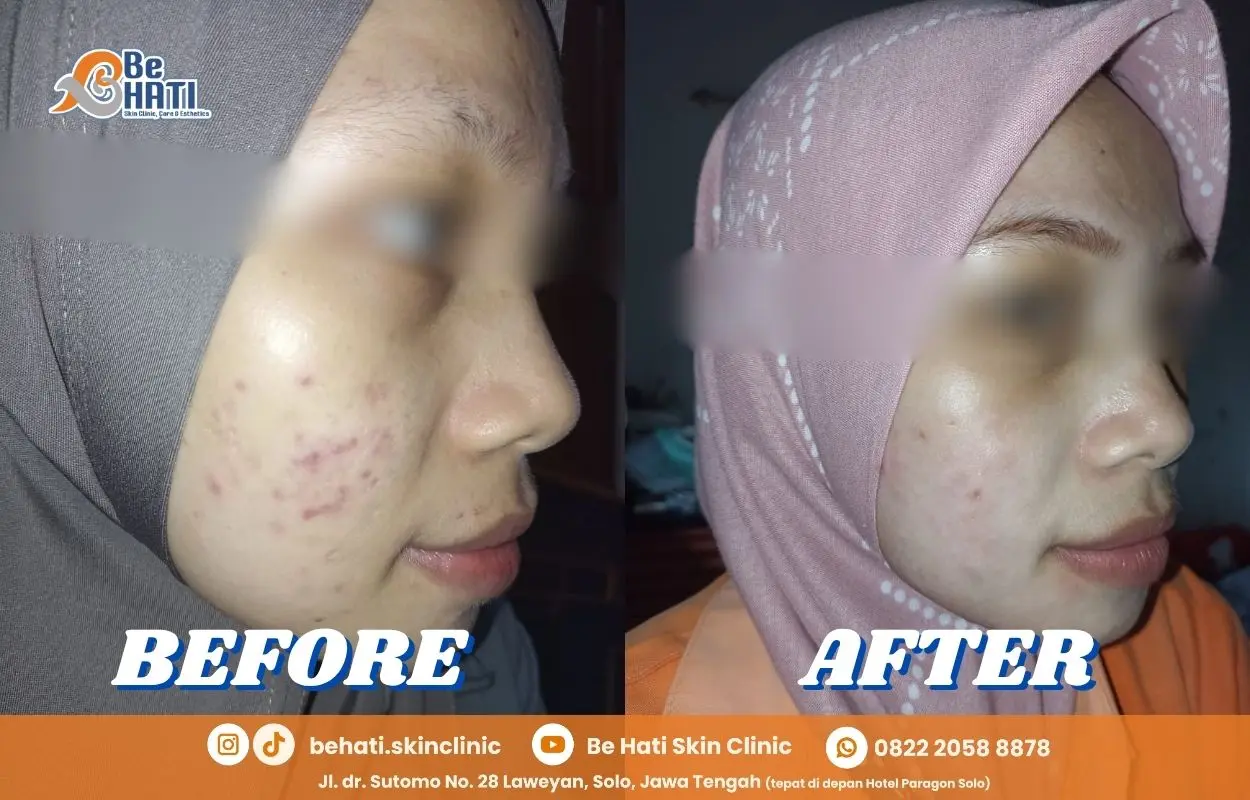 Perbandingan kondisi kulit sebelum dan sesudah perawatan di Be Hati 