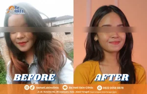 Perbandingan hasil sebelum dan sesudah perawatan kulit wajah di Be Hati Skin Clinic Solo.
