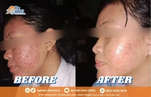Perbandingan wajah before & after perawatan Be Hati
