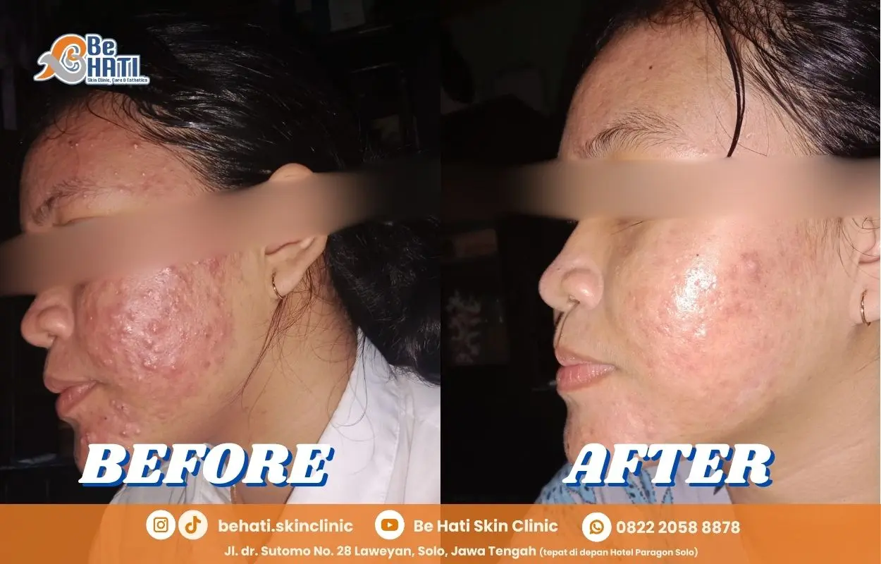 Perbandingan wajah before & after perawatan Be Hati
