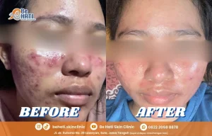 Kulit berjerawat sembuh di Be Hati