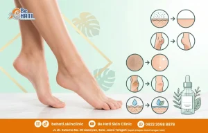 Chemical peeling kulit kaki