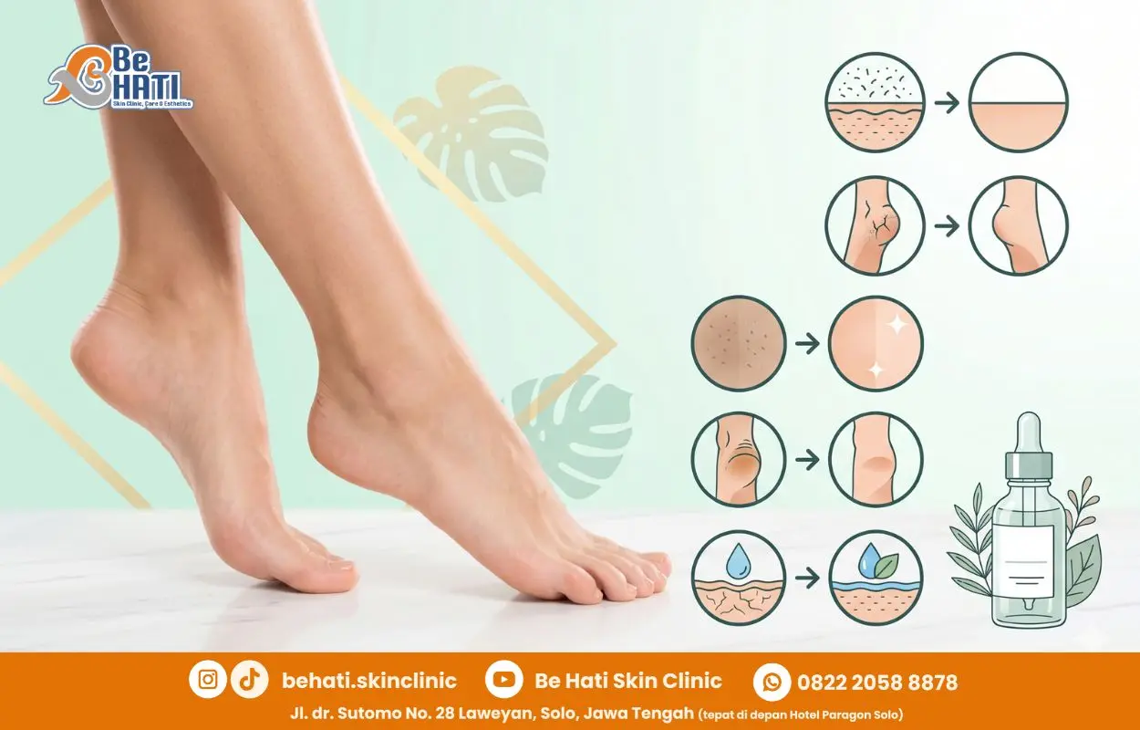 Chemical peeling kulit kaki