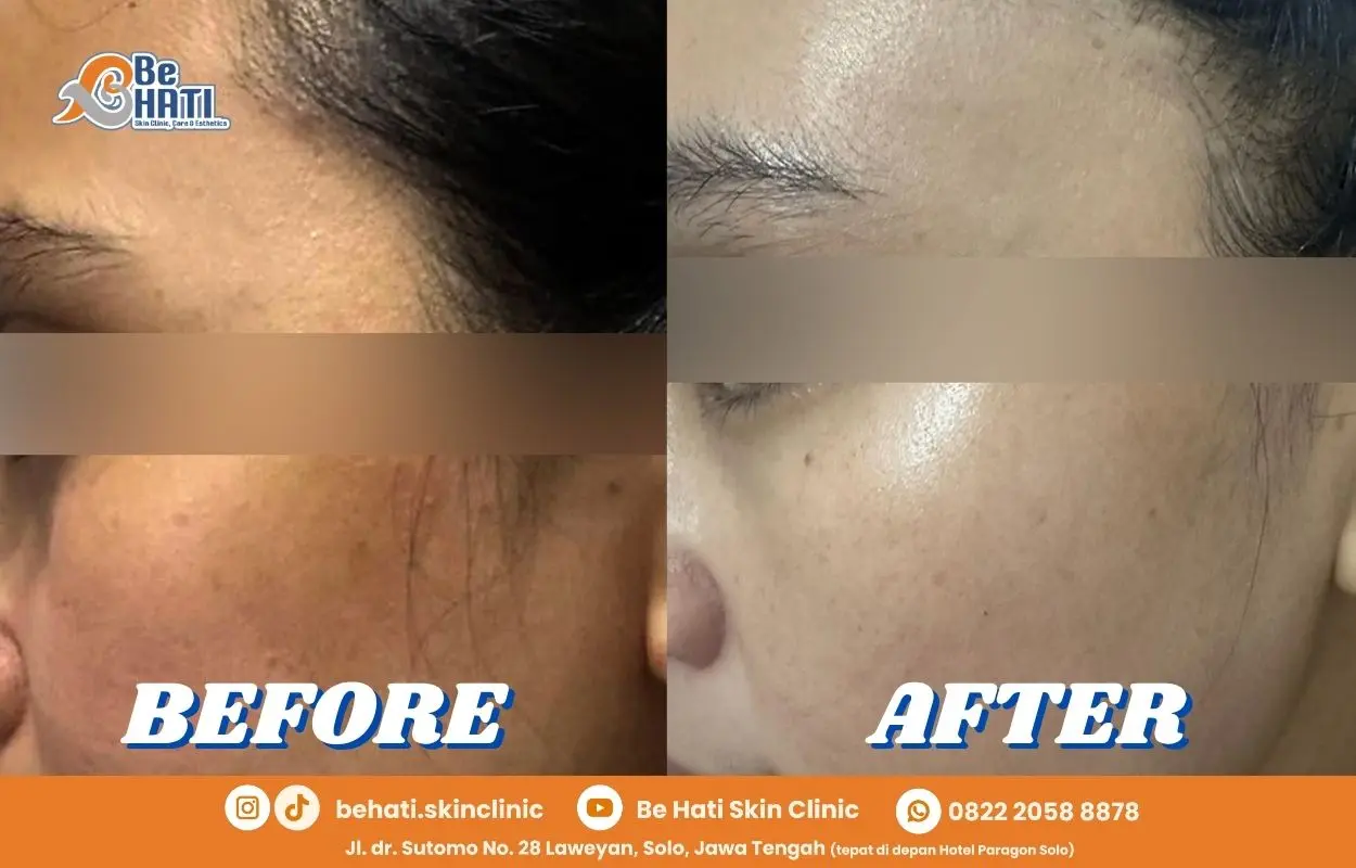 Ulasan Be Hati Skin Clinic