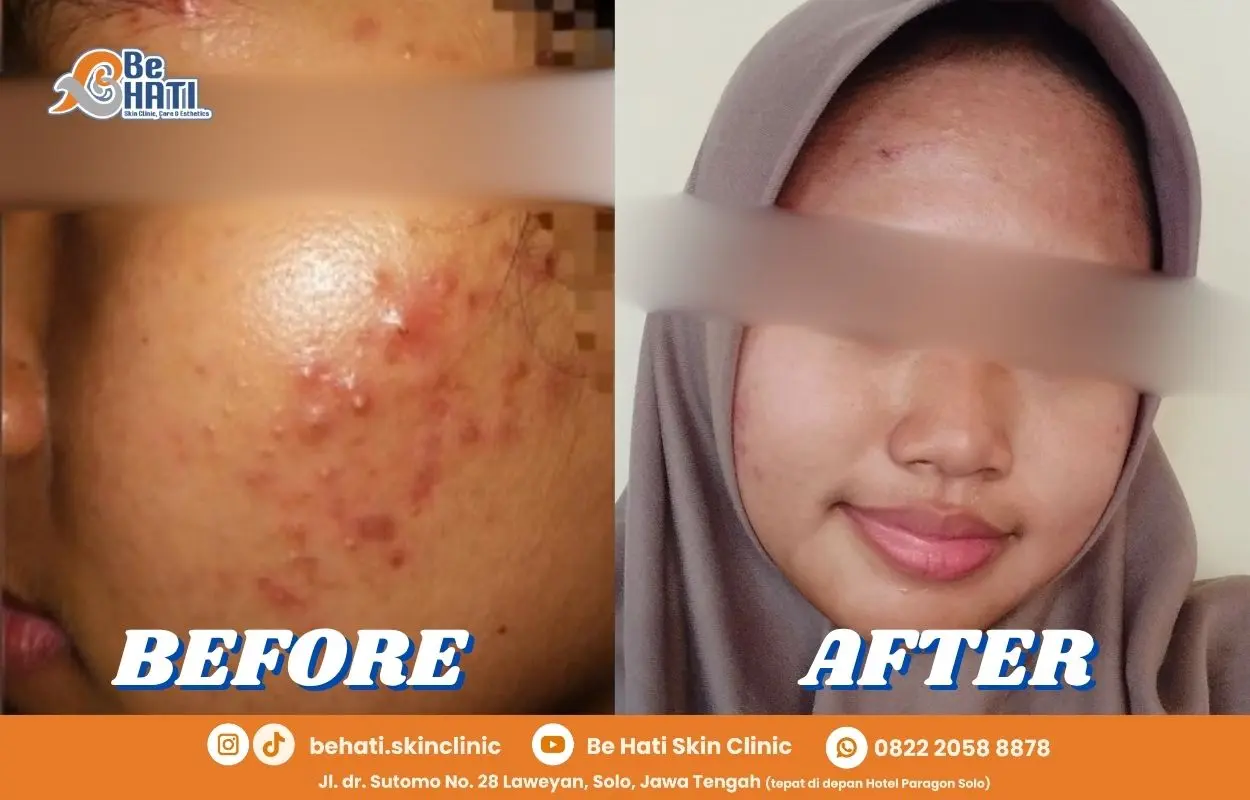 Perawatan jerawat di Be Hati