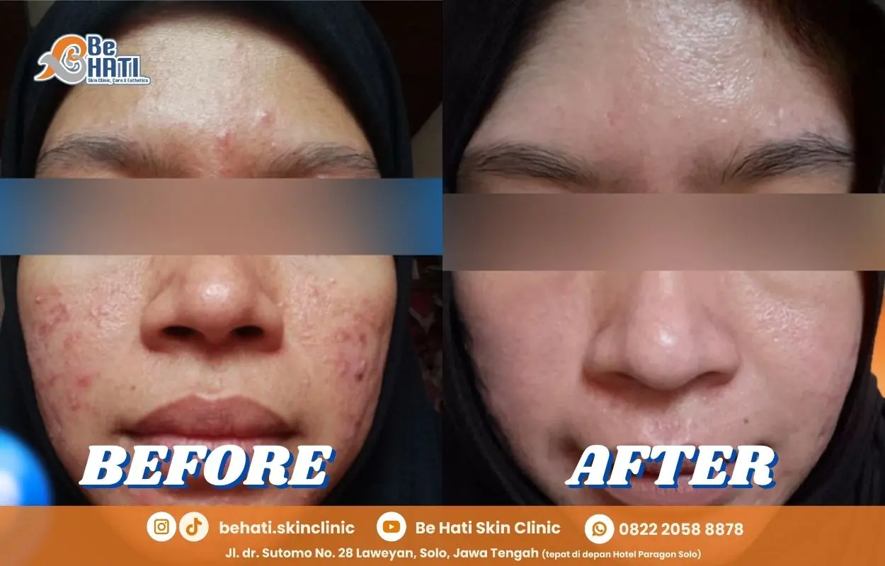 Jerawat sembuh di Be Hati Clinic