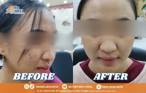 SkinJourney Be Hati