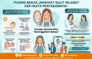 Penyebab bekas jerawat