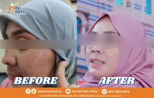 Menghilangkan flek hitam di wajah