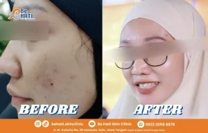 Jerawat sembuh di Be Hati Skin Clinic
