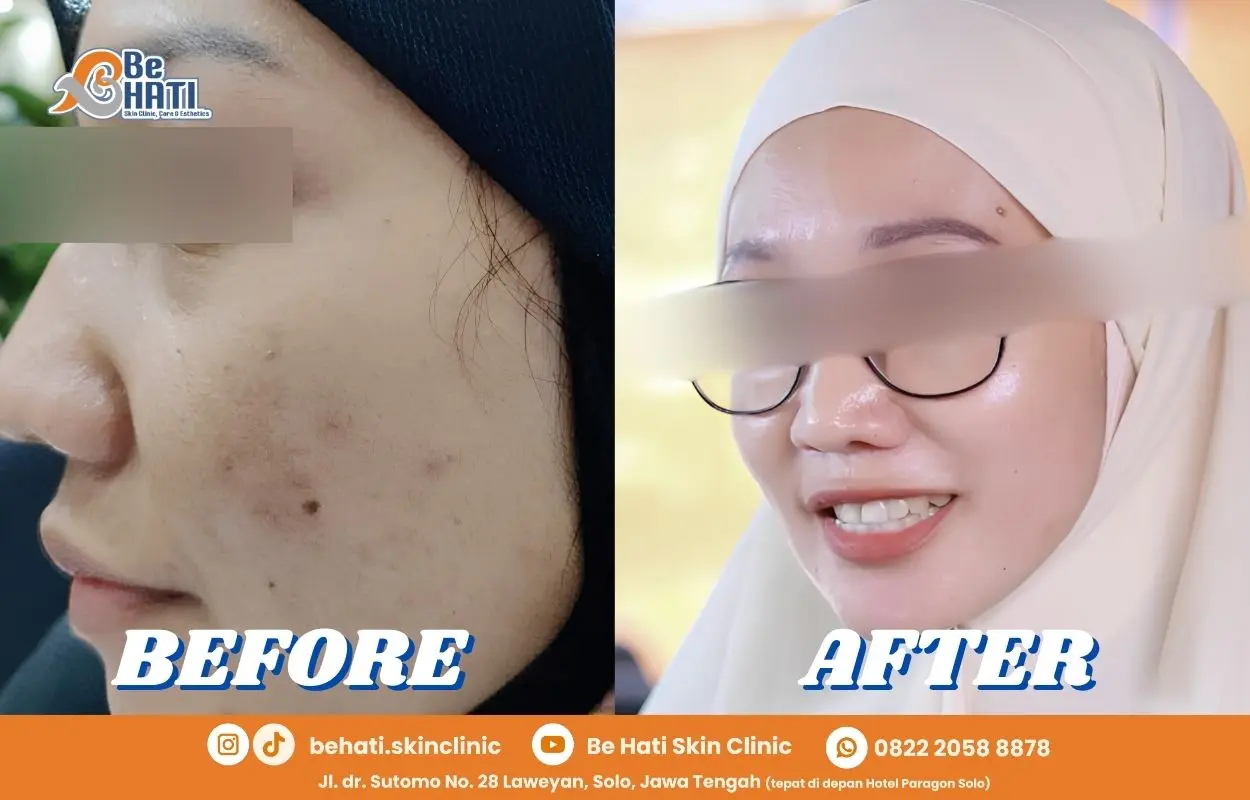 Jerawat sembuh di Be Hati Skin Clinic
