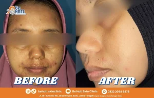 Rawat kulit berjerawat