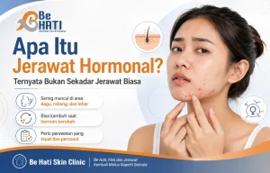 Perawatan jerawat di Be Hati Skin Clinic